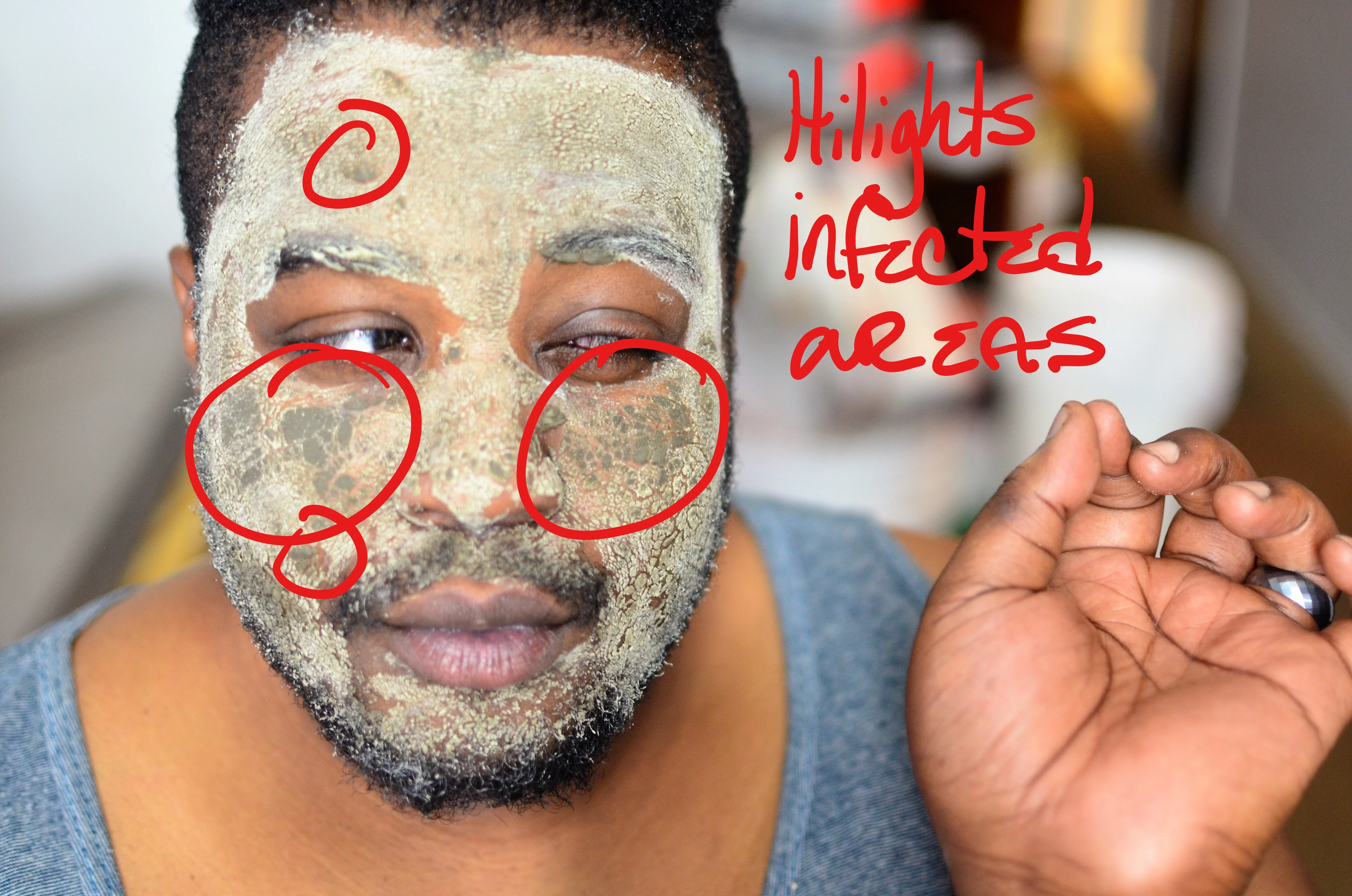 ZIT ZAPPER! ⚡Face Mask, Spot Treatment | Bentonite Clay X Tea Tree - Image 14
